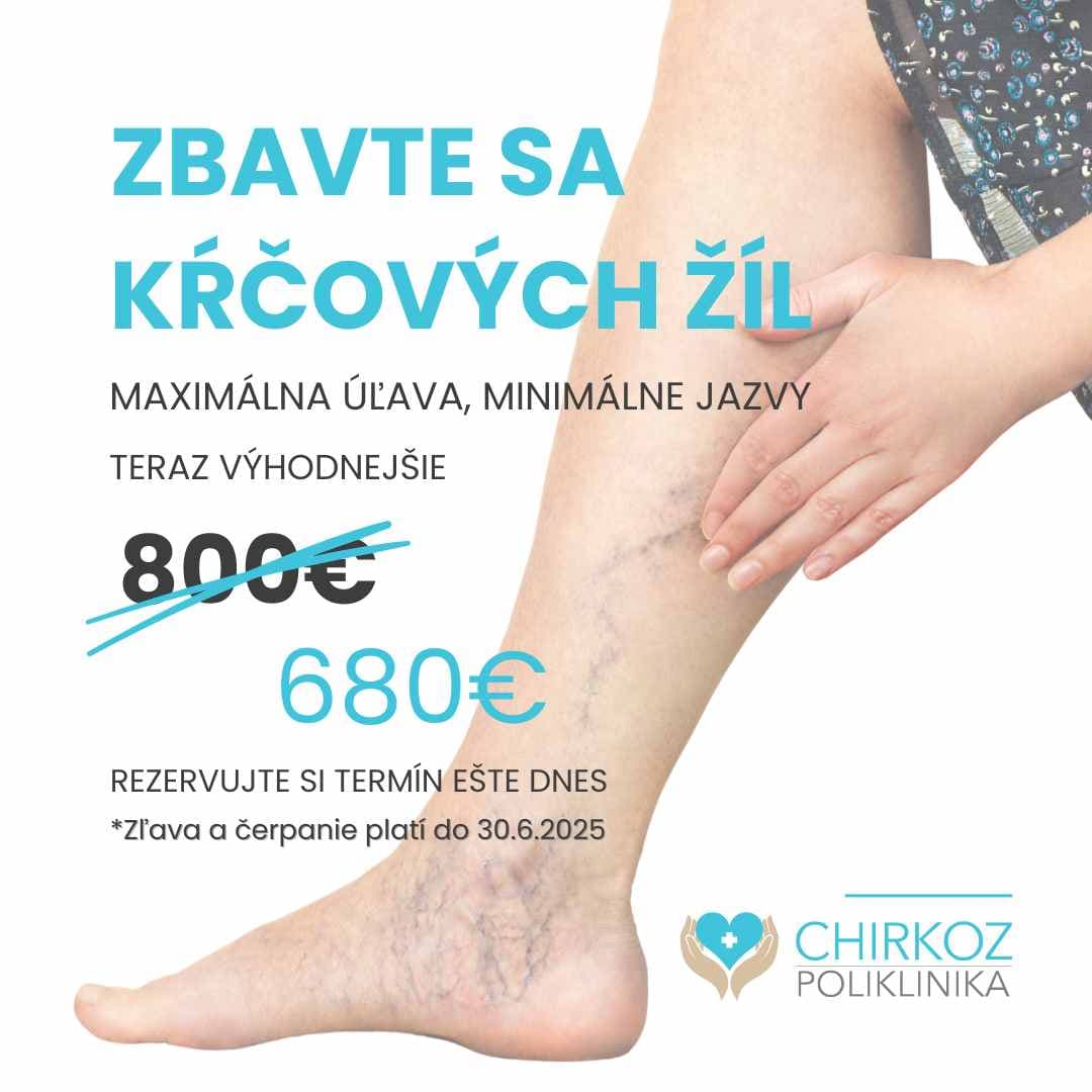 Get rid of varicose veins