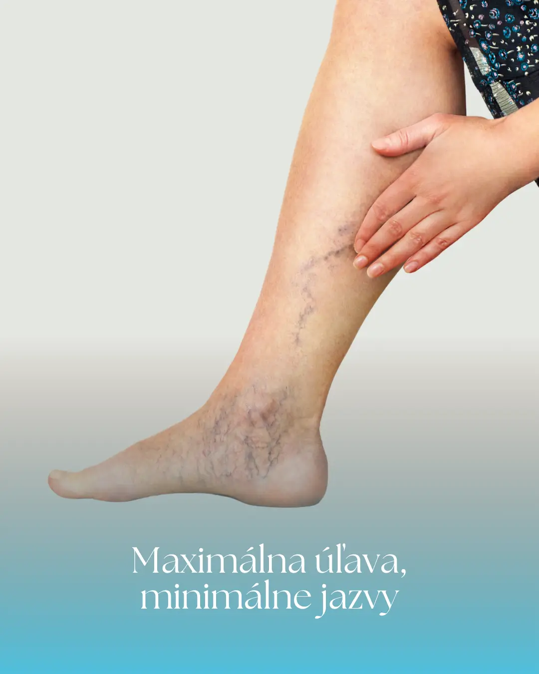 Miniflebektómia